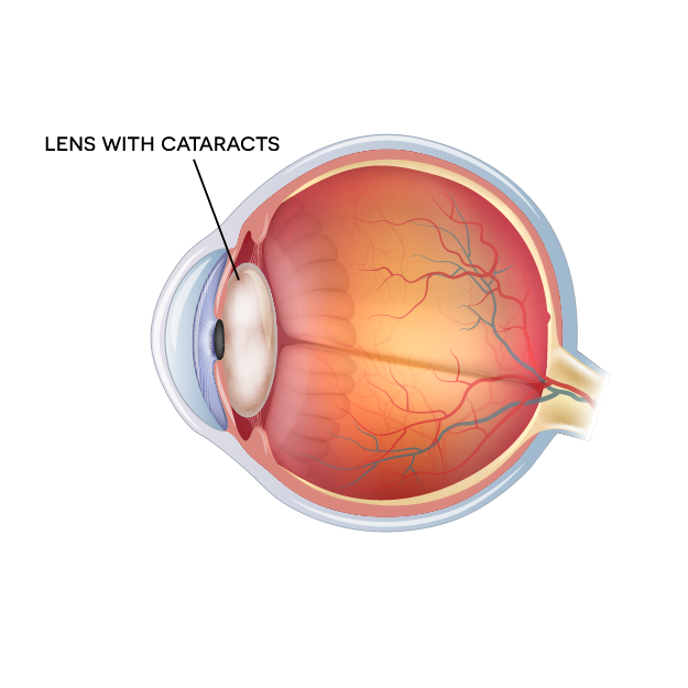 diagram of eye with cataract diagram of eye with cataract