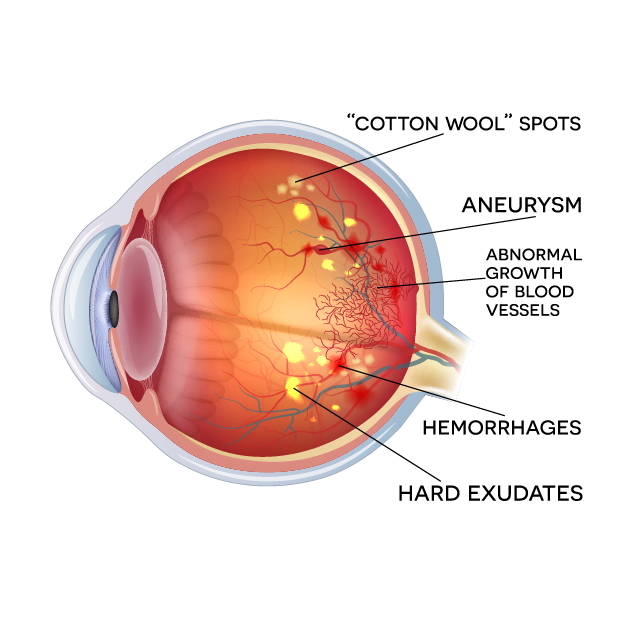 diagram of eye with Diabetic Retinopathy diagram of eye with Diabetic Retinopathy