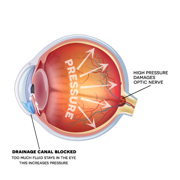 diagram of an eye with glaucoma diagram of an eye with glaucoma