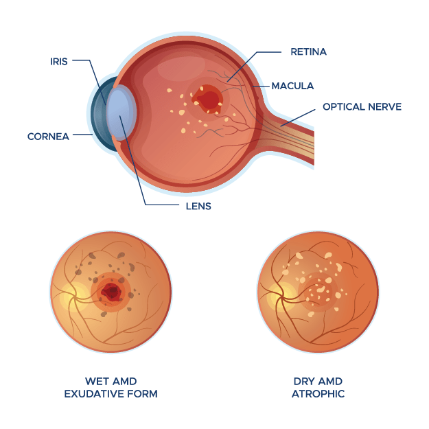 diagram of eye with macular degeneration diagram of eye with macular degeneration