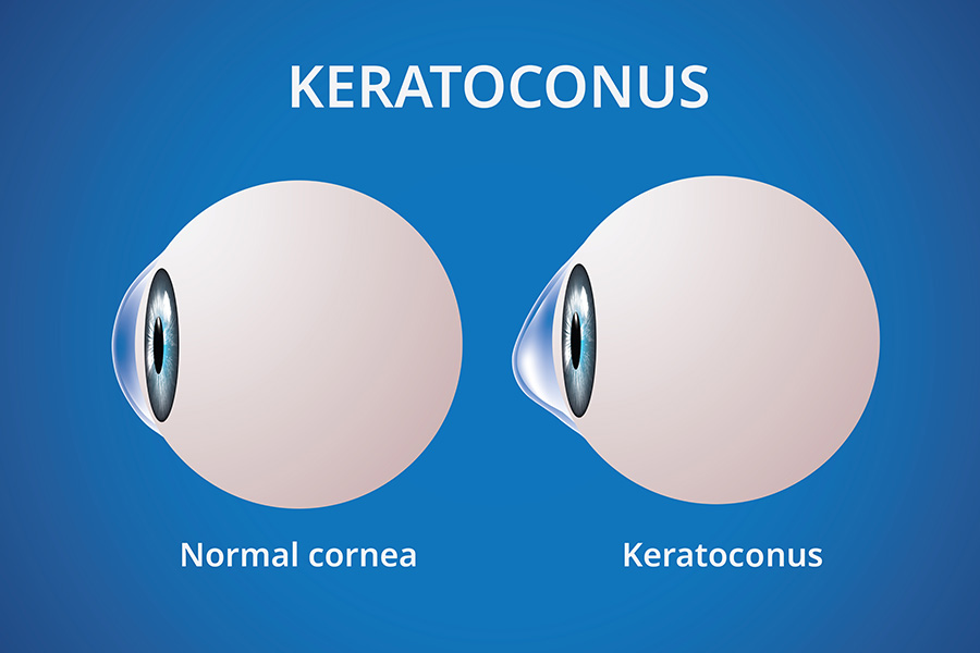 keratoconus diagram diagram of normal eye compared to keratoconus eye